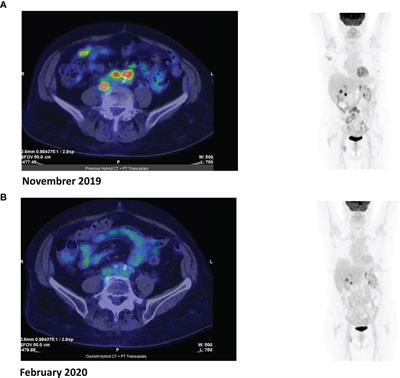 Venetoclax Shows Low Therapeutic Activity in BCL2-Positive Relapsed/Refractory Peripheral T-Cell Lymphoma: A Phase 2 Study of the Fondazione Italiana Linfomi